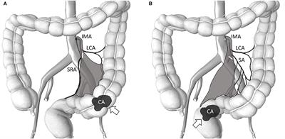 Oncological Outcomes of Robotic-Assisted Surgery With High Dissection and Selective Ligation Technique for Sigmoid Colon and Rectal Cancer